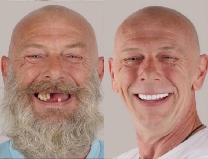Before and after, full arch patient