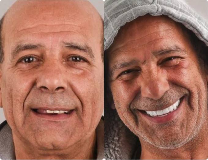 Before and after, full arch patient