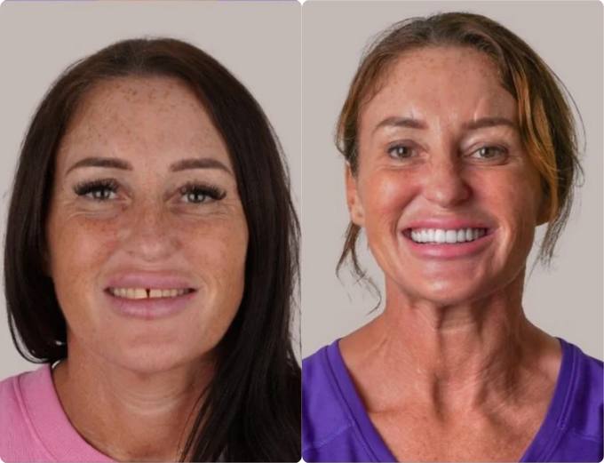 Before and after, smile restoration patient