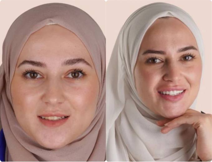 Before and after, smile restoration patient