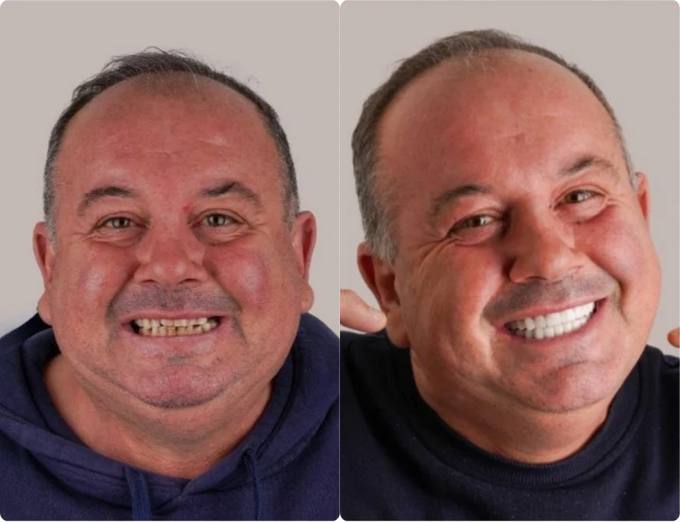 Before and after, full arch patient