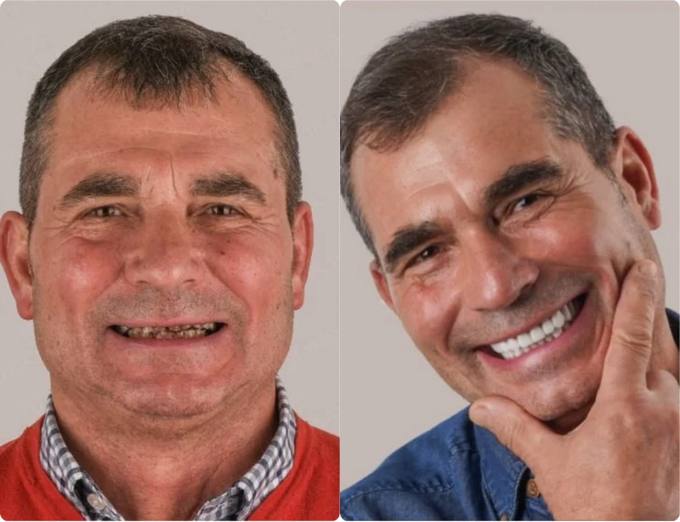 Before and after, full arch patient