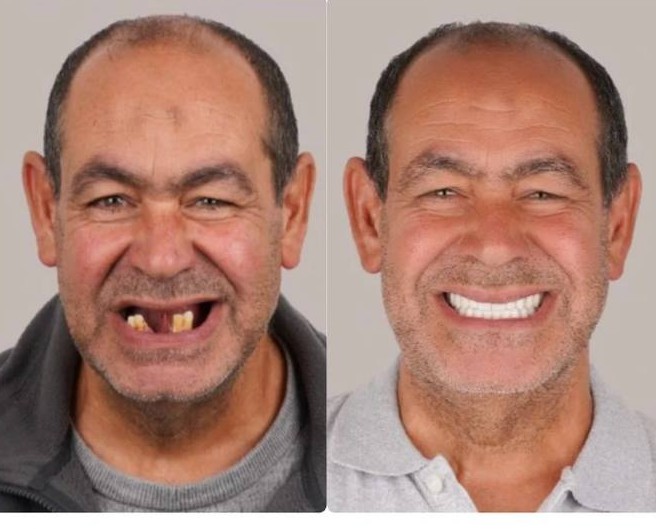Before and after, full arch patient