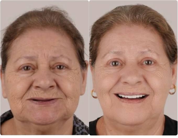 Before and after, full arch patient